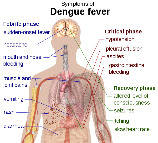 Dengue Fever Symptoms - The Symptoms Of Dengue Fever